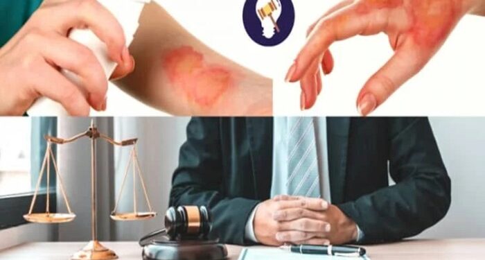 The Common Ways a Burn Injury Can Occur Due to Property Owner Negligence
